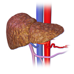 liver disease on the rise in United States